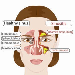 Sinus irrigation clearance