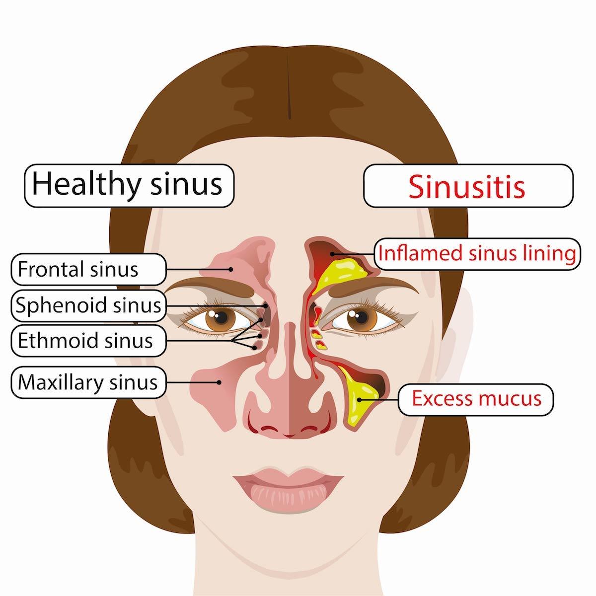 IS RINSING YOUR SINUSES WITH NETI POTS SAFE?